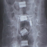 首(頚髄損傷)のレントゲン写真