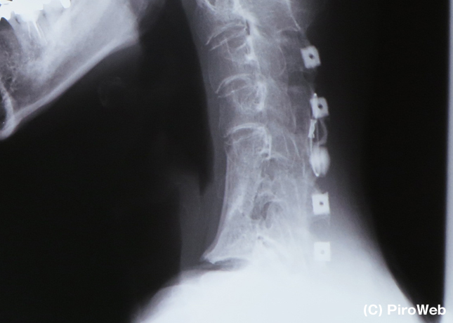 首(頚髄損傷)のレントゲン写真